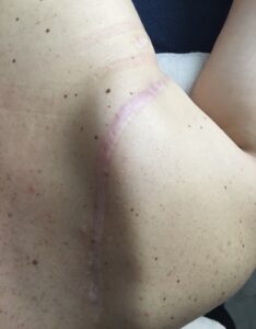 cicatrice travaillée en massage par massothérapie sportivce et avec ventouses