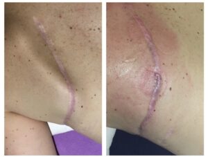 cicetrice lors d'un traitement de massothérapie thérapeutique en massage sportif avec ventouse